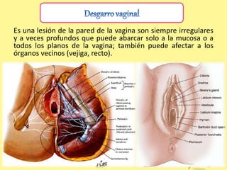 Es una lesión de la pared de la vagina son siempre irregulares
y a veces profundos que puede abarcar solo a la mucosa o a
todos los planos de la vagina; también puede afectar a los
órganos vecinos (vejiga, recto).
 