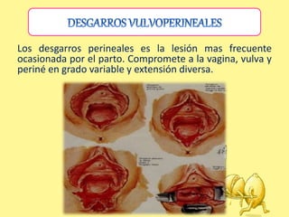Los desgarros perineales es la lesión mas frecuente
ocasionada por el parto. Compromete a la vagina, vulva y
periné en grado variable y extensión diversa.
 