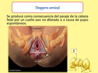 Se produce como consecuencia del pasaje de la cabeza
fetal por un cuello aun no dilatado o a causa de pujos
espontáneos.
 