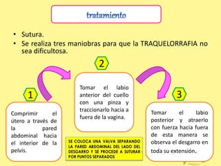 • Sutura.
• Se realiza tres maniobras para que la TRAQUELORRAFIA no
sea dificultosa.
Comprimir el
útero a través de
la pared
abdominal hacia
el interior de la
pelvis.
Tomar el labio
anterior del cuello
con una pinza y
traccionarlo hacia a
fuera de la vagina.
Tomar el labio
posterior y atraerlo
con fuerza hacia fuera
de esta manera se
observa el desgarro en
toda su extensión.
1
2
3
 