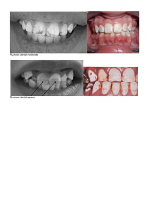 Fluorosis dental moderada




Fluorosis dental severa
 