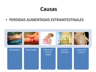 Causas
• PERDIDAS AUMENTADAS EXTRAINTESTINALES




 Quemaduras   Hemorragias    Poliuria de   Diuresis   Sudoración
                              diverso      osmótica     profusa
                               origen
 