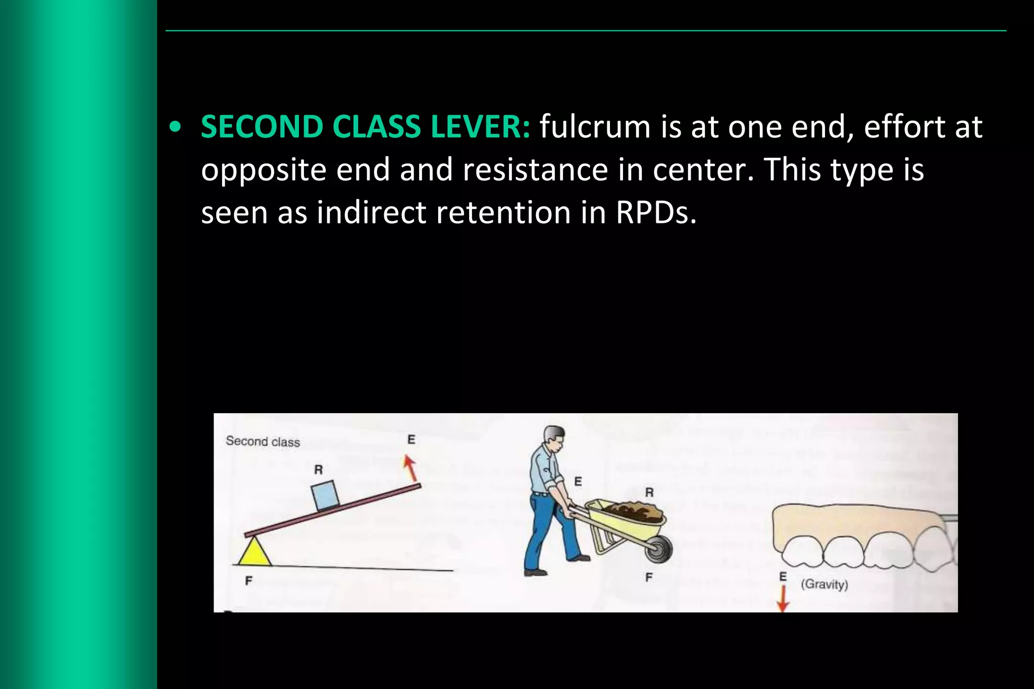 Lever Arm Rpd Designing of rpd | PPTX