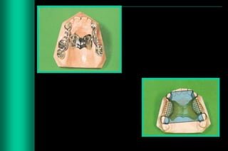 Designing of rpd | PPTX