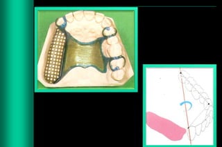 Interiem Rpd Designing of rpd | PPTX