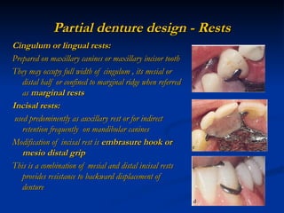 Embrasure Rest Rpd designing of rpd.ppt designing of denture | PPT