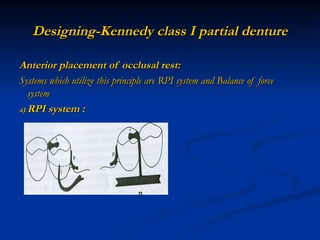 designing of rpd.ppt designing of denture | PPT