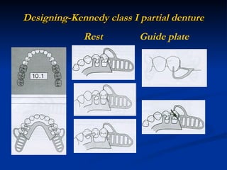 designing of rpd.ppt designing of denture | PPT