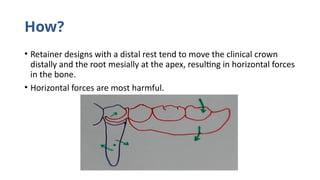 designing principles of teeth less areas.pptx