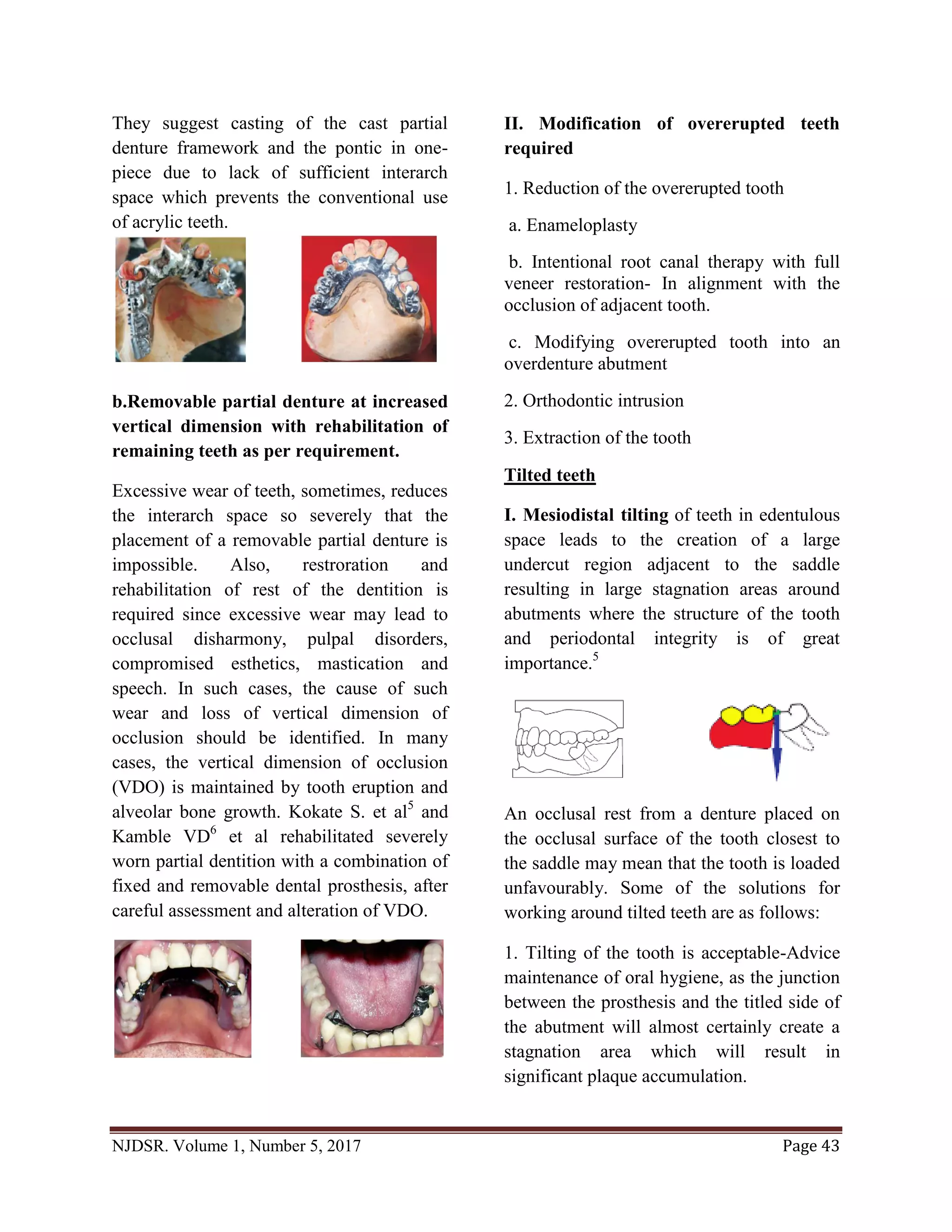 Designing removable partial dentures around difficult dentition | PDF