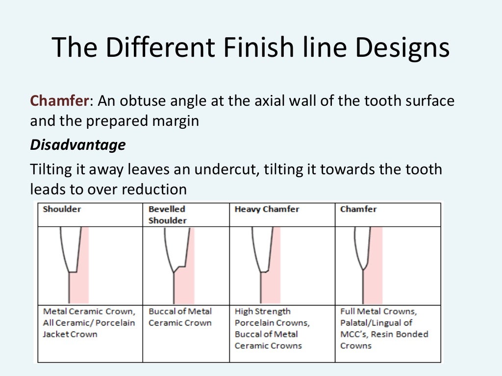 Design of a fixed Partial Denture (with Abutment Tooth Preparation)