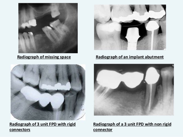 Design Of A Fixed Partial Denture With Abutment Tooth Preparation