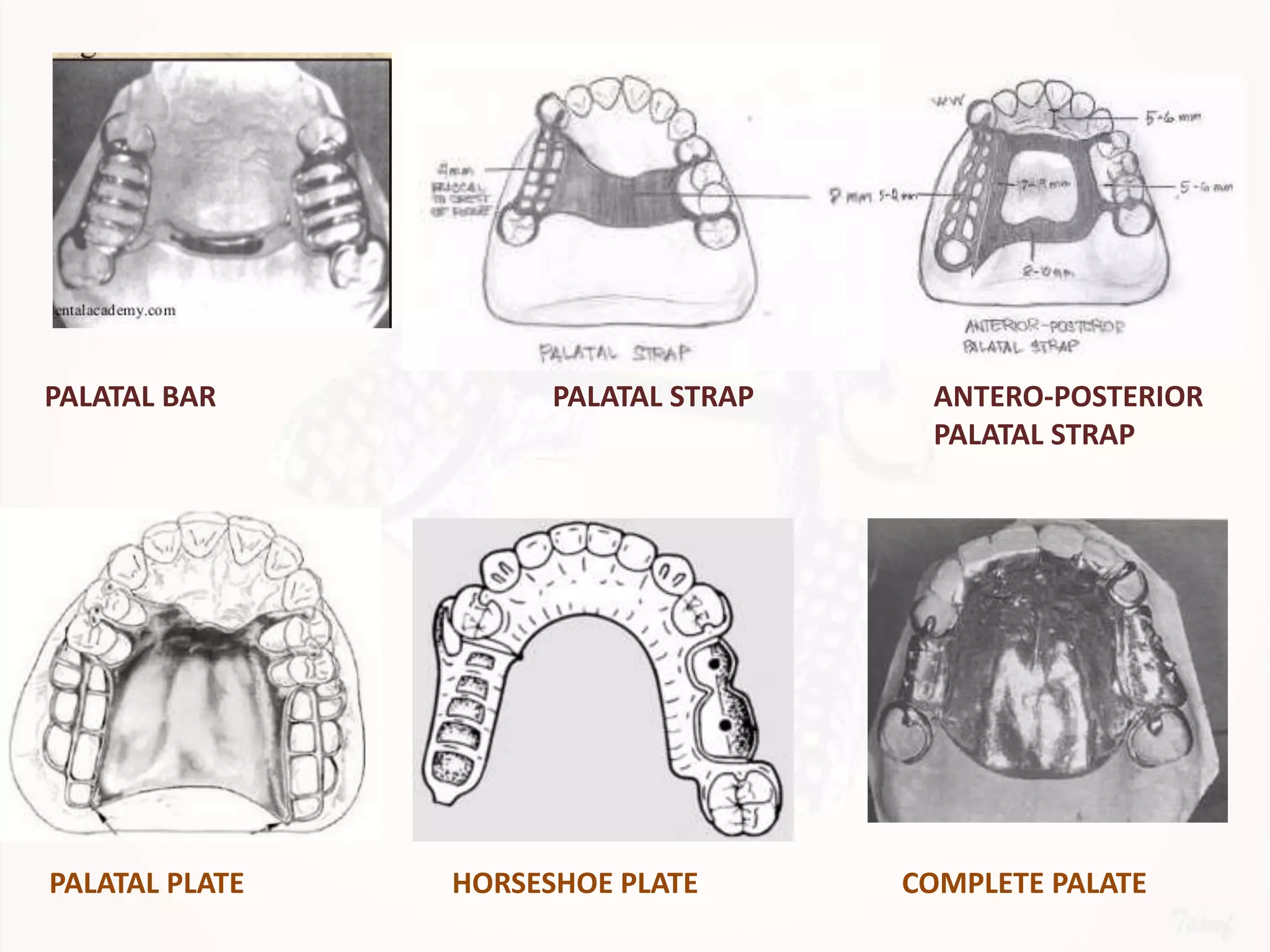 Designing a Removable Partial Denture (Kennedy's Classification)