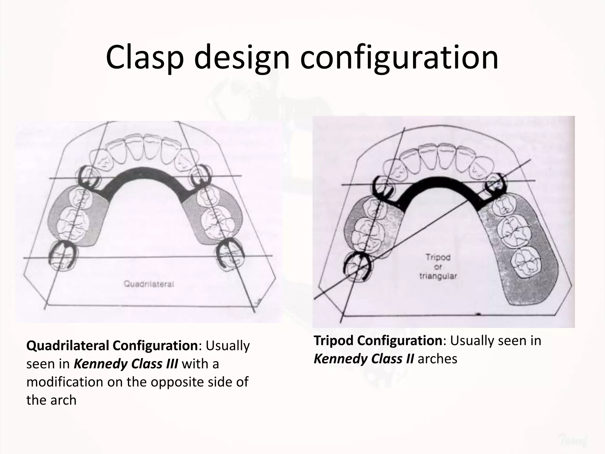 Designing a Removable Partial Denture (Kennedy's Classification)