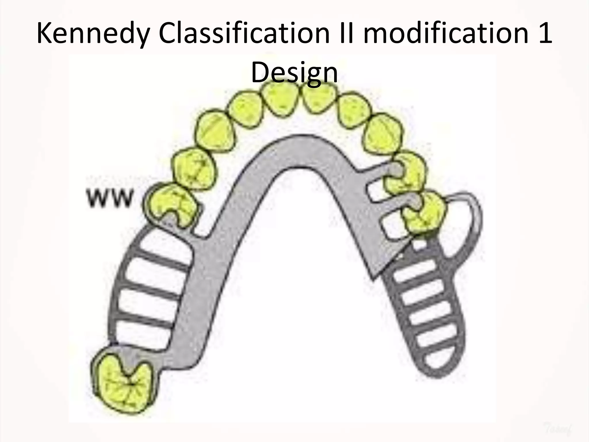 Designing a Removable Partial Denture (Kennedy's Classification)