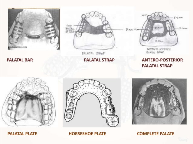 Designing a Removable Partial Denture (Kennedy's Classification) | PPTX