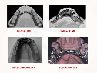 LINGUAL BAR LINGUAL PLATE
DOUBLE LINGUAL BAR SUBLINGUAL BAR
 
