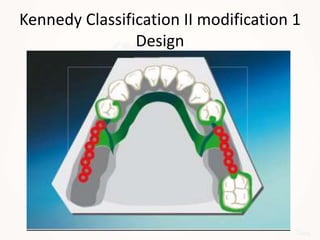 Kennedy Classification II modification 1
Design
 