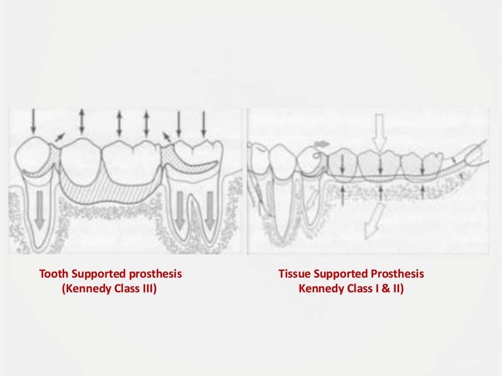 Designing a Removable Partial Denture (Kennedy's Classification)