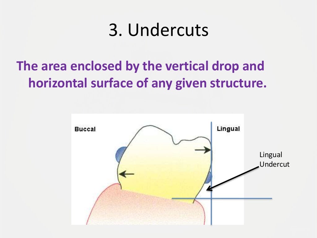 Designing a Removable Partial Denture (Kennedy's Classification)