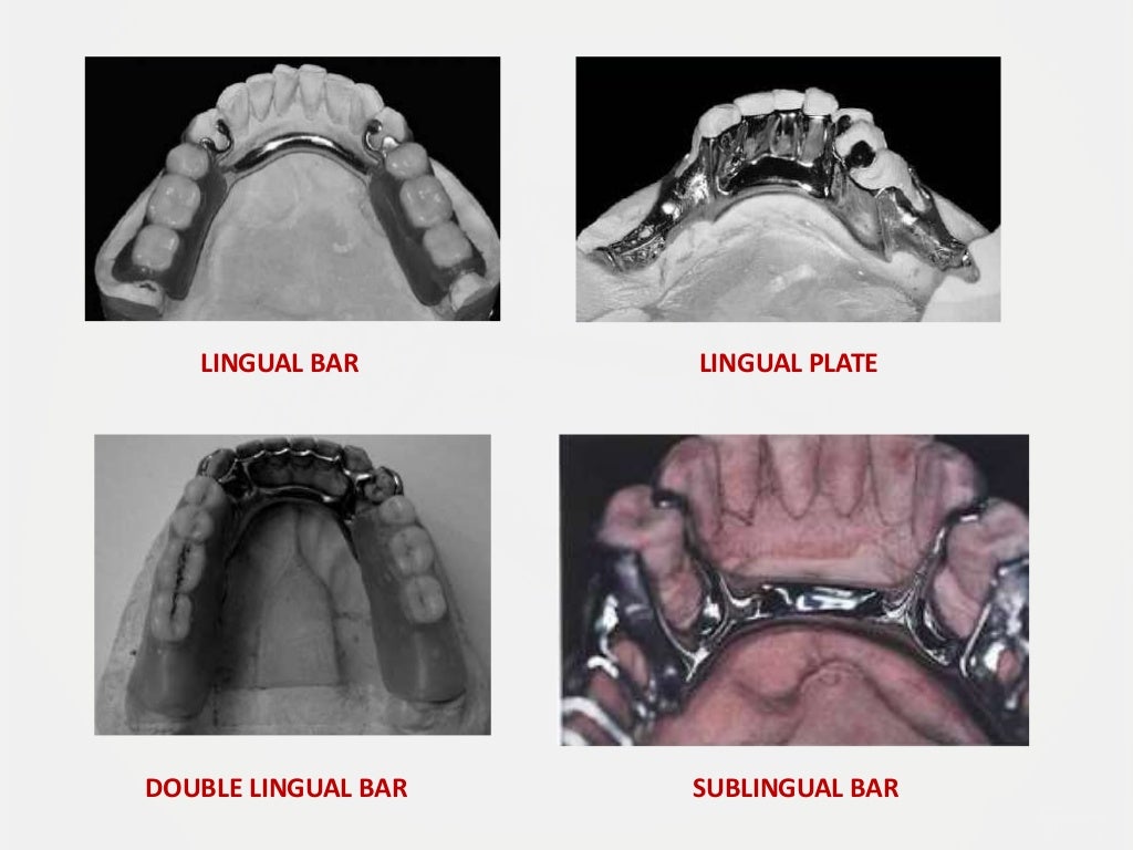 Designing a Removable Partial Denture (Kennedy's Classification)