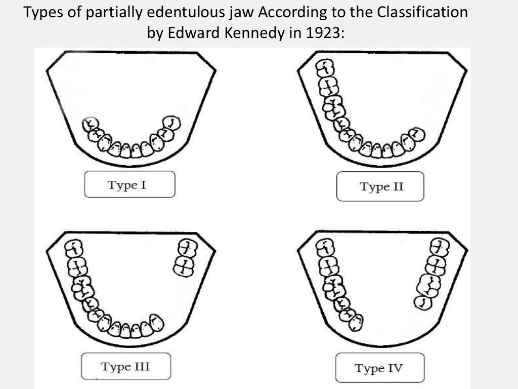 Designing a Removable Partial Denture (Kennedy's Classification)