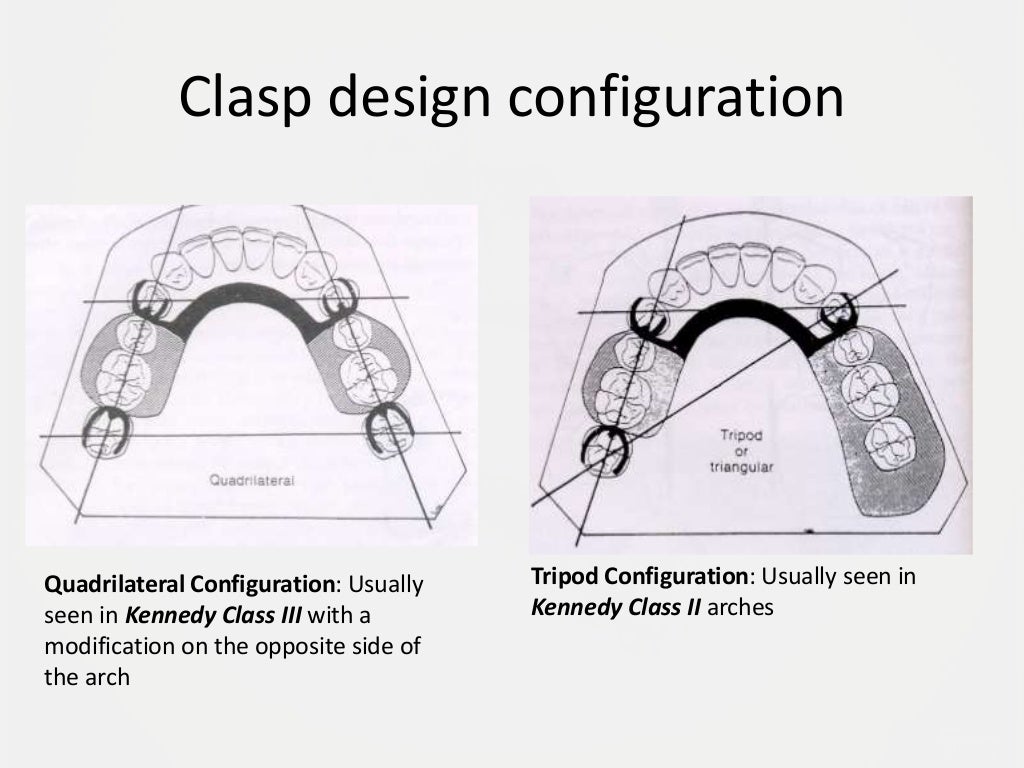 Designing a Removable Partial Denture (Kennedy's Classification)