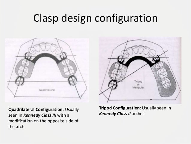 Drawing Removable Partial Denture Design  : Planning The Design For Removable Partial Dentures— Presentation Transcript