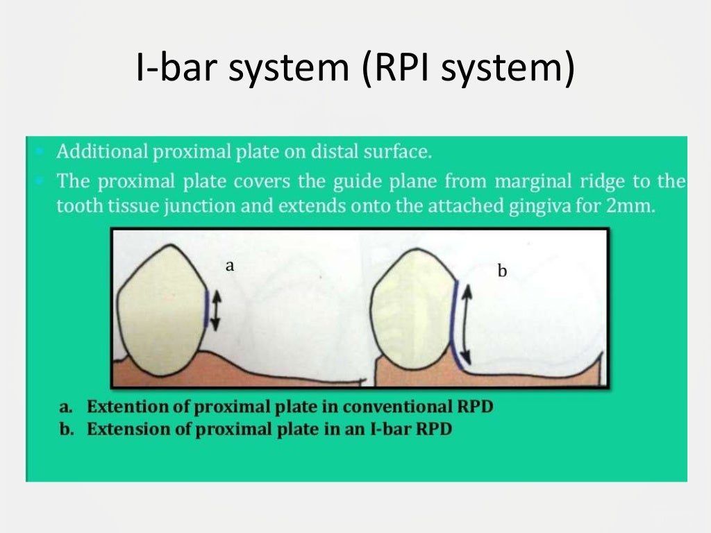 Designing a Removable Partial Denture (Kennedy's Classification)