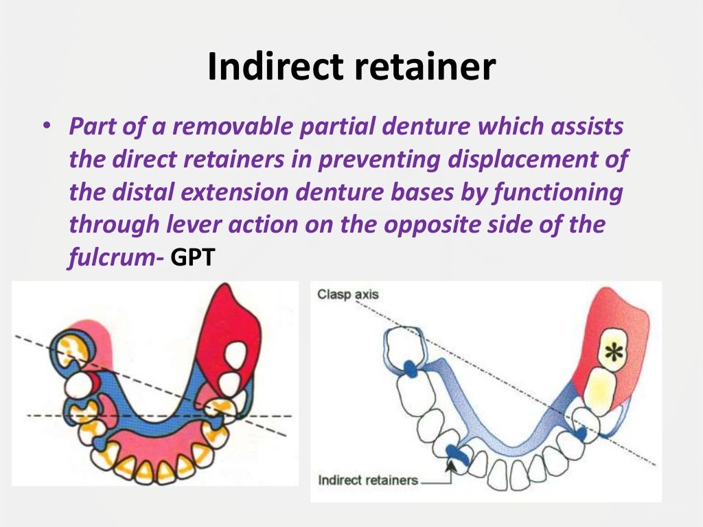Designing a Removable Partial Denture (Kennedy's Classification)