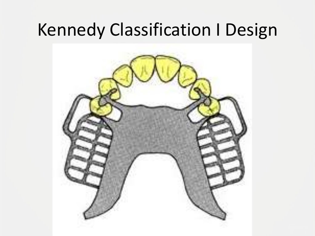 Designing a Removable Partial Denture (Kennedy's Classification)