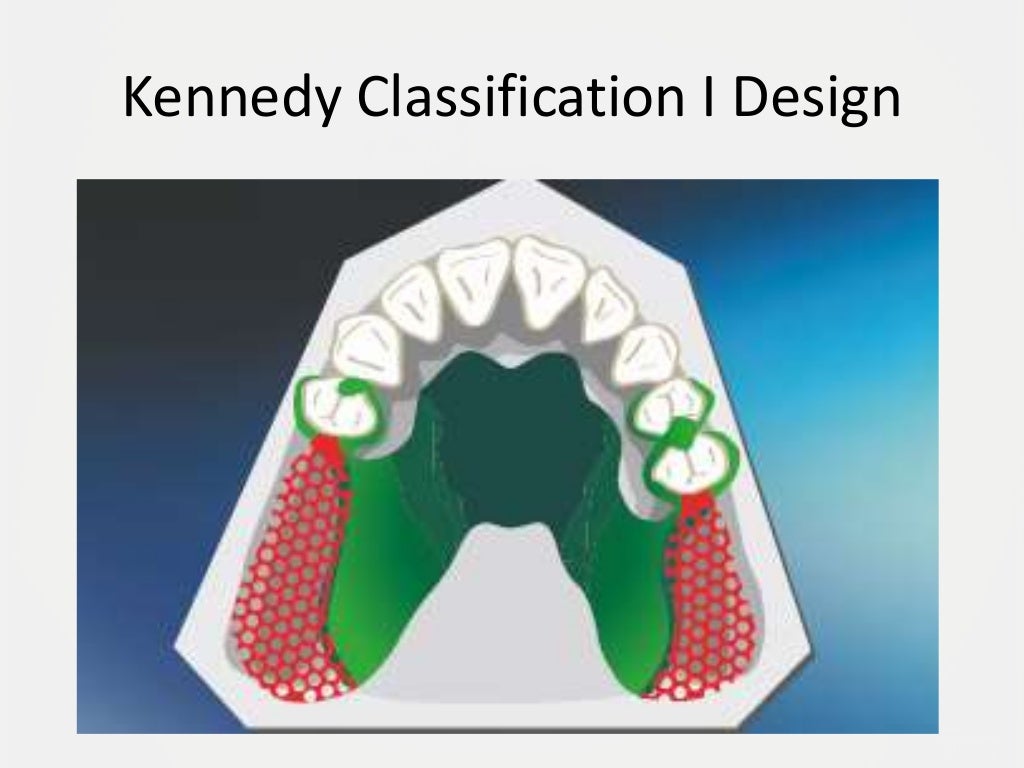Designing a Removable Partial Denture (Kennedy's Classification)