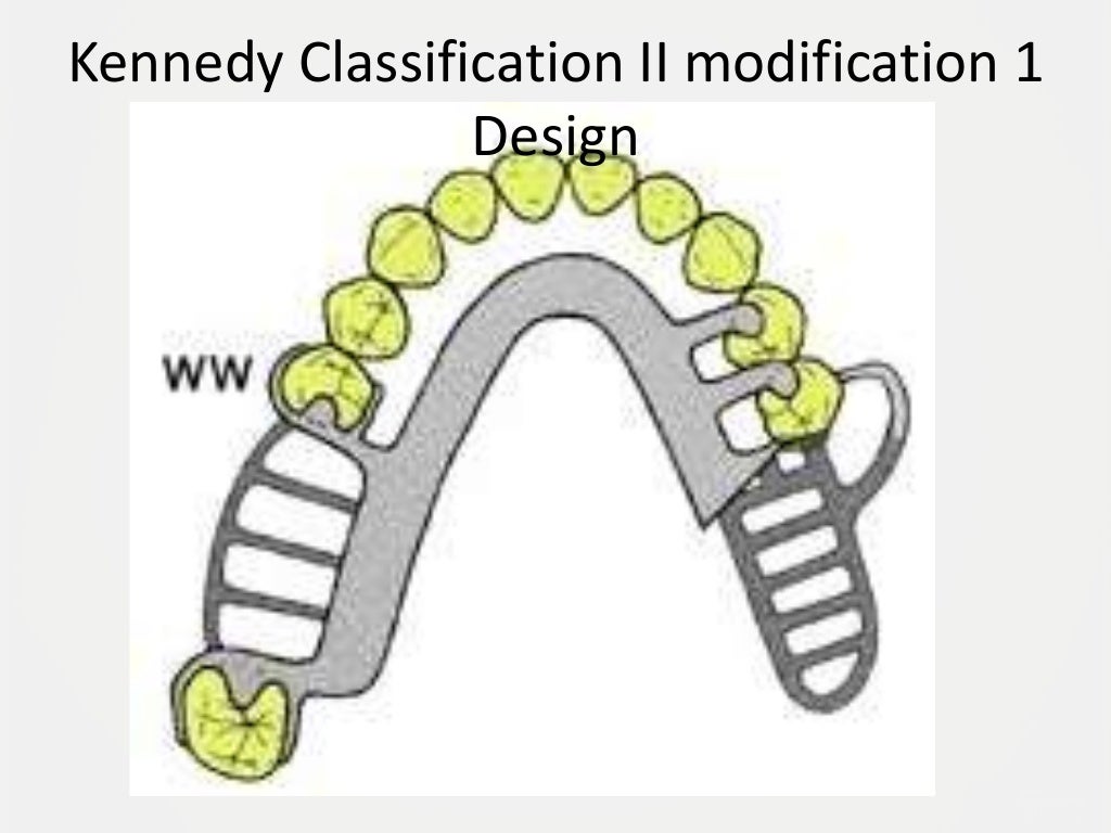 Designing a Removable Partial Denture (Kennedy's Classification)