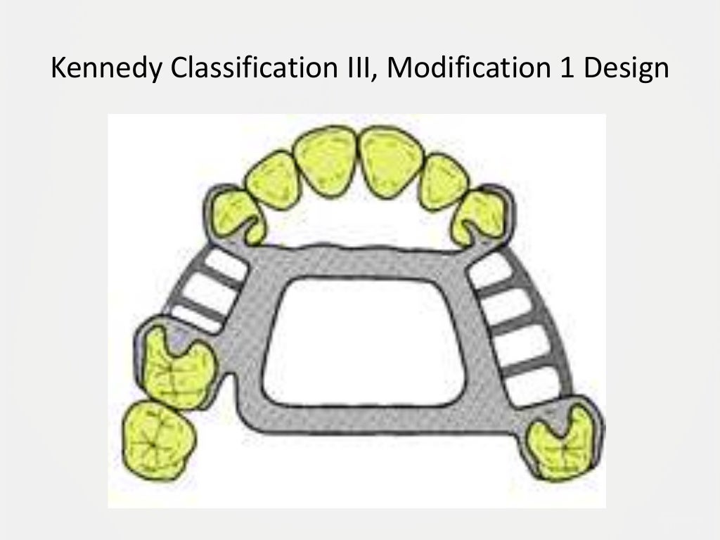 Designing a Removable Partial Denture (Kennedy's Classification)