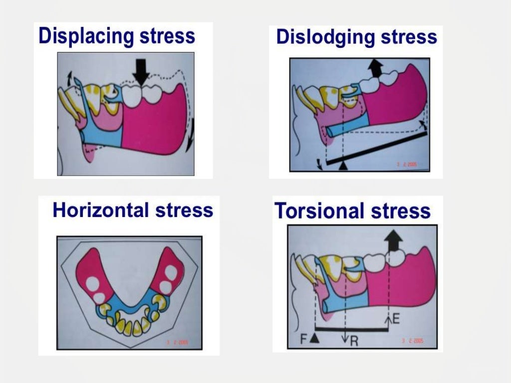 Designing a Removable Partial Denture (Kennedy's Classification)