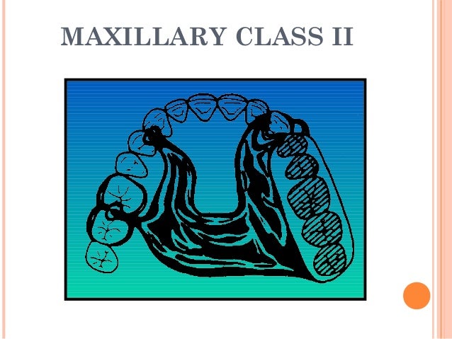 Design of removable partial denture