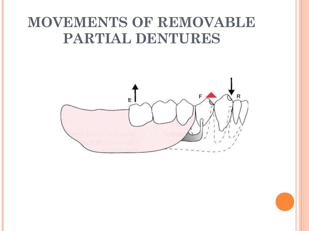 Design of removable partial denture