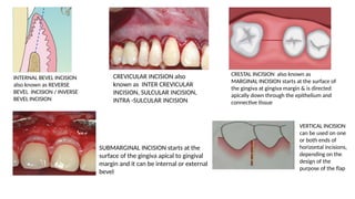 Design of Flap operations in periodontics | PPTX