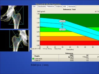 Edad 51 a. / 2005
Steroid & Multi fractures
 
