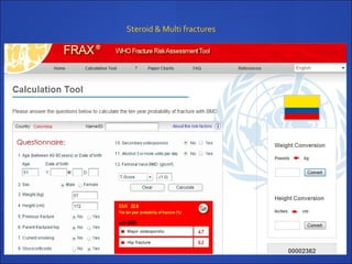 Steroid & Multi fractures
 