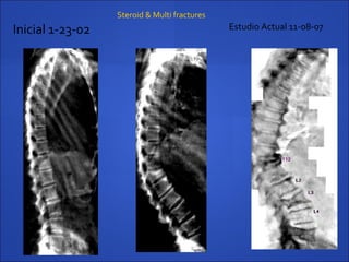 Inicial 1-23-02 Estudio Actual 11-08-07
Steroid & Multi fractures
T12
 
