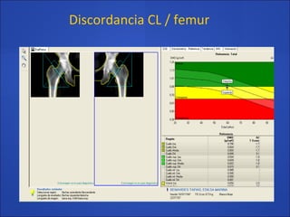 Discordancia CL / femur
 