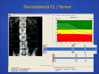 Discordancia CL / femur
 
