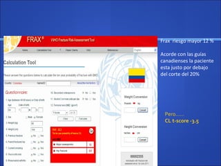 Frax riesgo mayor 12 %
Acorde con las guías
canadienses la paciente
esta justo por debajo
del corte del 20%
Pero……
CL t-score -3.5
 