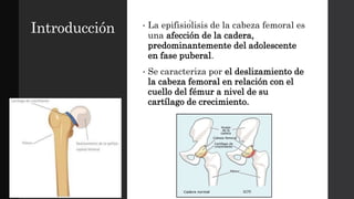 Introducción • La epifisiólisis de la cabeza femoral es
una afección de la cadera,
predominantemente del adolescente
en fase puberal.
• Se caracteriza por el deslizamiento de
la cabeza femoral en relación con el
cuello del fémur a nivel de su
cartílago de crecimiento.
 