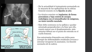 • En la actualidad el tratamiento aconsejado en
la mayoría de las epifisiólisis de la cabeza
femoral consiste en la fijación in situ.
• La técnica consiste en implantar, de forma
percutánea y bajo control de escopia
radiológica con el intensificador de imágenes,
un único tornillo canulado.
• Este debe centrarse en la epífisis y quedar
orientado perpendicular a la fisis; por ello,
cuanto mayor sea el desplazamiento, más
anterior deberá ser el punto de entrada en el
cuello femoral.
Las osteotomías femorales son útiles para
corregir las deformidades residuales severas e
intentar recuperar la anatomía y la función
normales de la cadera.
 