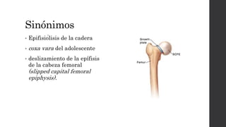 Sinónimos
• Epifisiólisis de la cadera
• coxa vara del adolescente
• deslizamiento de la epífisis
de la cabeza femoral
(slipped capital femoral
epiphysis).
 