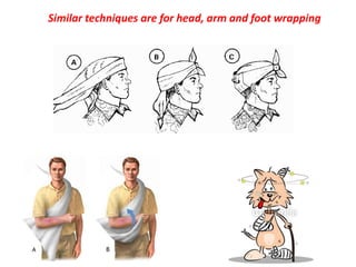 Similar techniques are for head, arm and foot wrapping
 