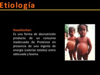 Kwashiorkor:
Es una forma de desnutrición
producto de un consumo
inadecuado de Proteinas en
presencia de una ingesta de
energía (calorías totales) entre
adecuada y buena.
 