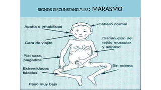 1 DESNUTRICIÓN EN PEDIATRIA EPIDEMIOLOGIA | PPTX